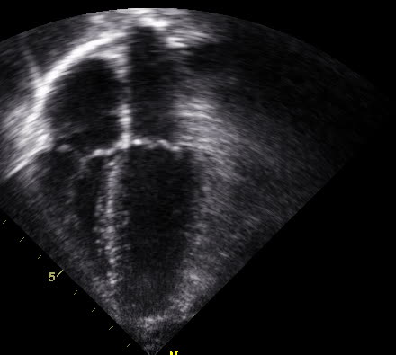 Échocardiographie, coupe apicale des quatre cavités